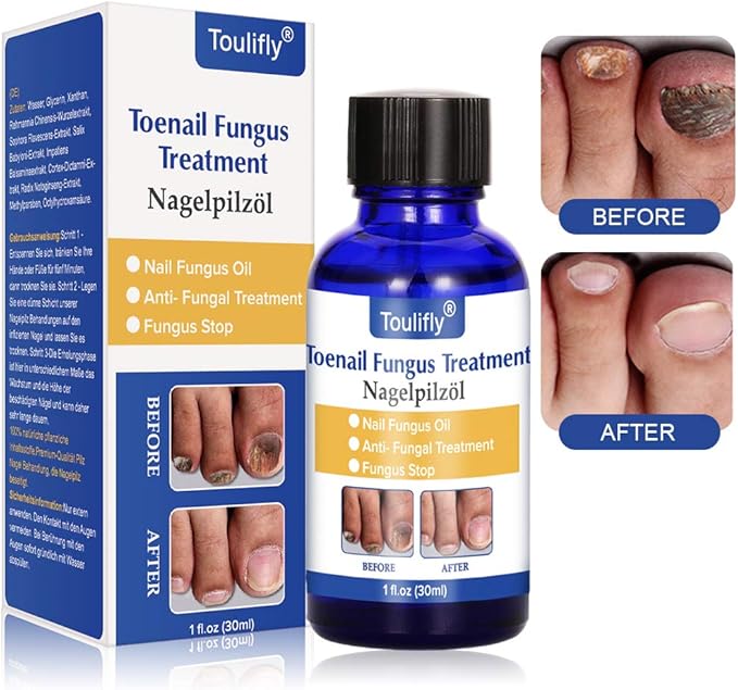 Fungus stop, fungo, trattamento anti Fungus nail trattamento, efficace