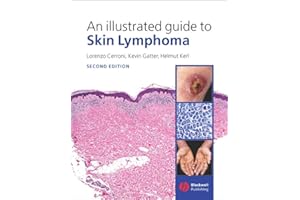 An Illustrated Guide to Skin Lymphoma