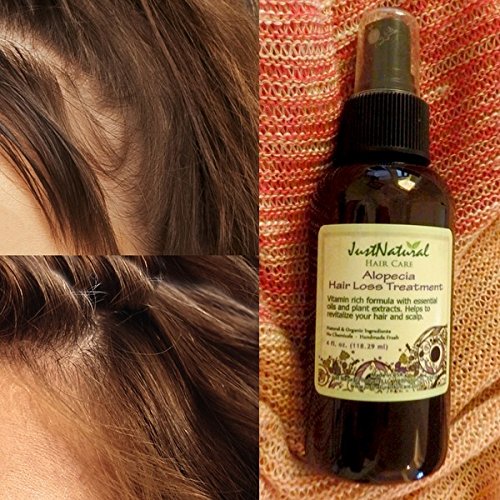 Buy Alopecia Hair Loss Treatment Online At Low Prices In India