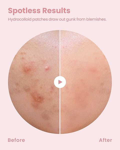 GLAM UP HYDROCOLLOID BLEMISH PIMPLE ZIT PATCHES – INVISIBLE ULTRA THIN SPOT COVER STICKERS FOR FACE AND SKIN, STRONG WATER-PROOF AND ADHESIVE OVERNIGHT, VEGAN-FRIENDLY (36 COUNT / 2 SIZES)