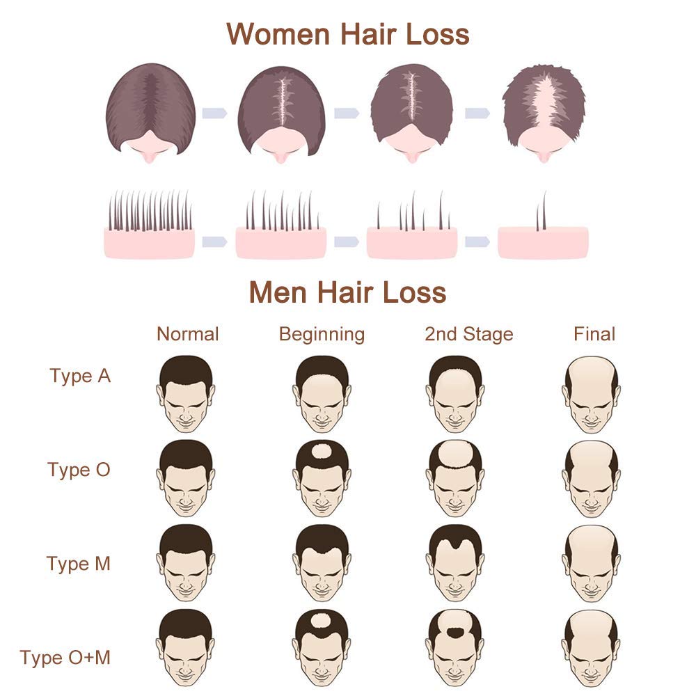 Hair Grow Spray, Anti Hair Loss, Thinning, Balding, Natural Ingredients Hair Regrowth Treatment for Stronger, Thicker, Longer Hair Grow, Repair Hair Follicles, All Hair Types, Men and Women : Beauty