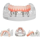 Dental Typodont Implant Transparent Model, Lower Jaw Type, Removable All-on-4 Restoration Overdenture, with 4 Implants (Lower Jaw -M6027)