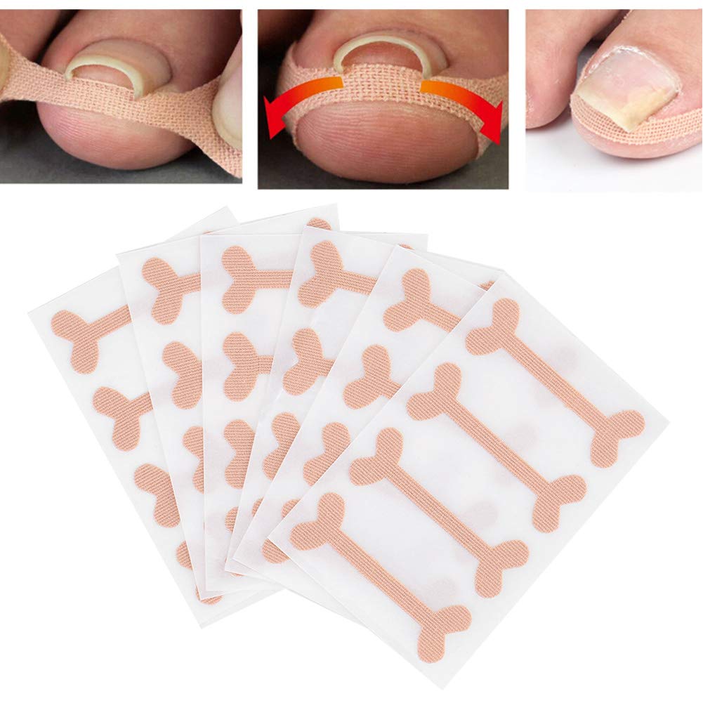 24pcs Ingrown Toenail Bandage, Toenail Correction Patch