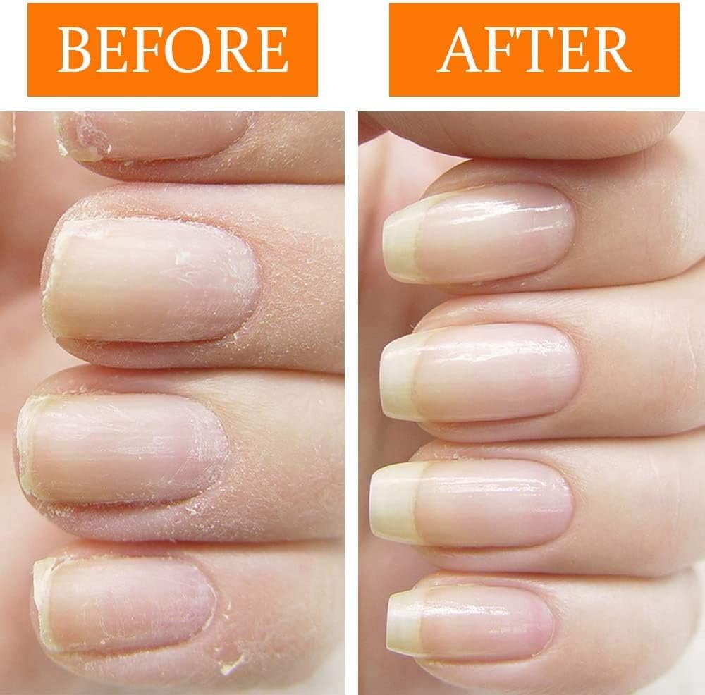 NailTek Nail Recovery Kit, Cuticle Oil, Strengthener, Ridge Filler - restore damaged nails in 3 steps: Beauty
