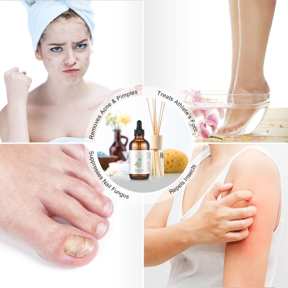 Tea Tree Essential Oil, Large 4 oz Bottle, 100% Pure & Natural, Undiluted Therapeutic Grade, Treats Acne, Cutaneous Skin Tags, Bacterial Infections, Nail Fungus