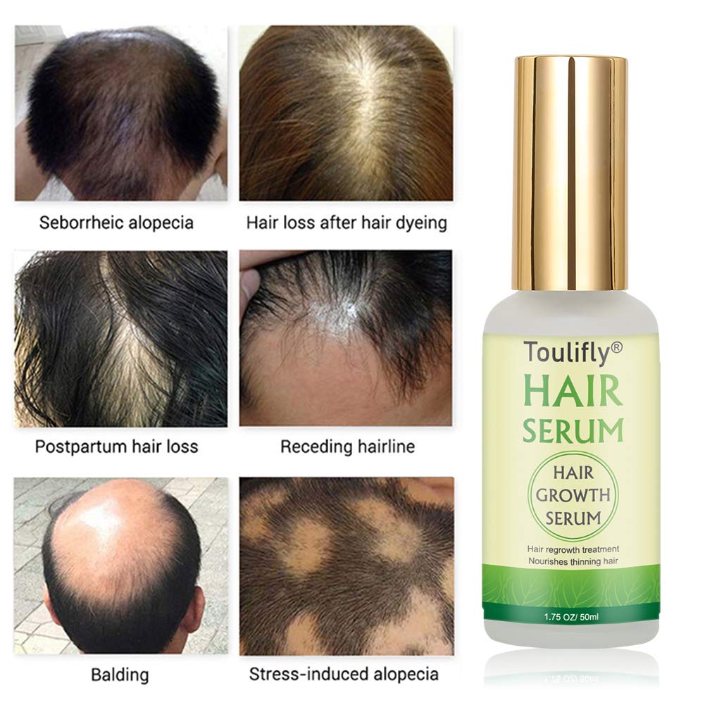 Hair Growth Serum, Hair Loss and Hair Thinning Treatment, Stops Hair Loss, Natural Herbal Essence, Thinning, Balding, Repairs Hair Follicles, Promotes Thicker, Stronger Hair and New Hair Growth(50ml) : Beauty