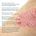 New Antifungal Cream for Athletes Foot, Ringworm, Jock Itch, Psoriasis, Eczema, Dermatitis and Other Types of Stubborn Skin Rashes. Safe, Effective & Fast Acting