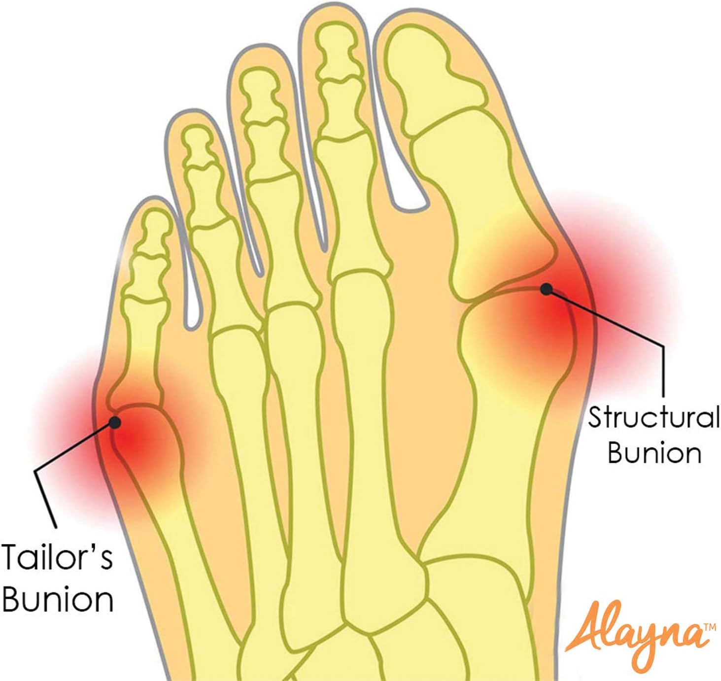 Bunion Corrector and Bunion Relief Gel Pad Big Toe Brace Cushion Hammer Toe Pain and Inflammation Relief Unisex Bunion Guard Shield Fits Inside Socks and Shoes to Correct and Align Bones in Feet: Health & Personal Care