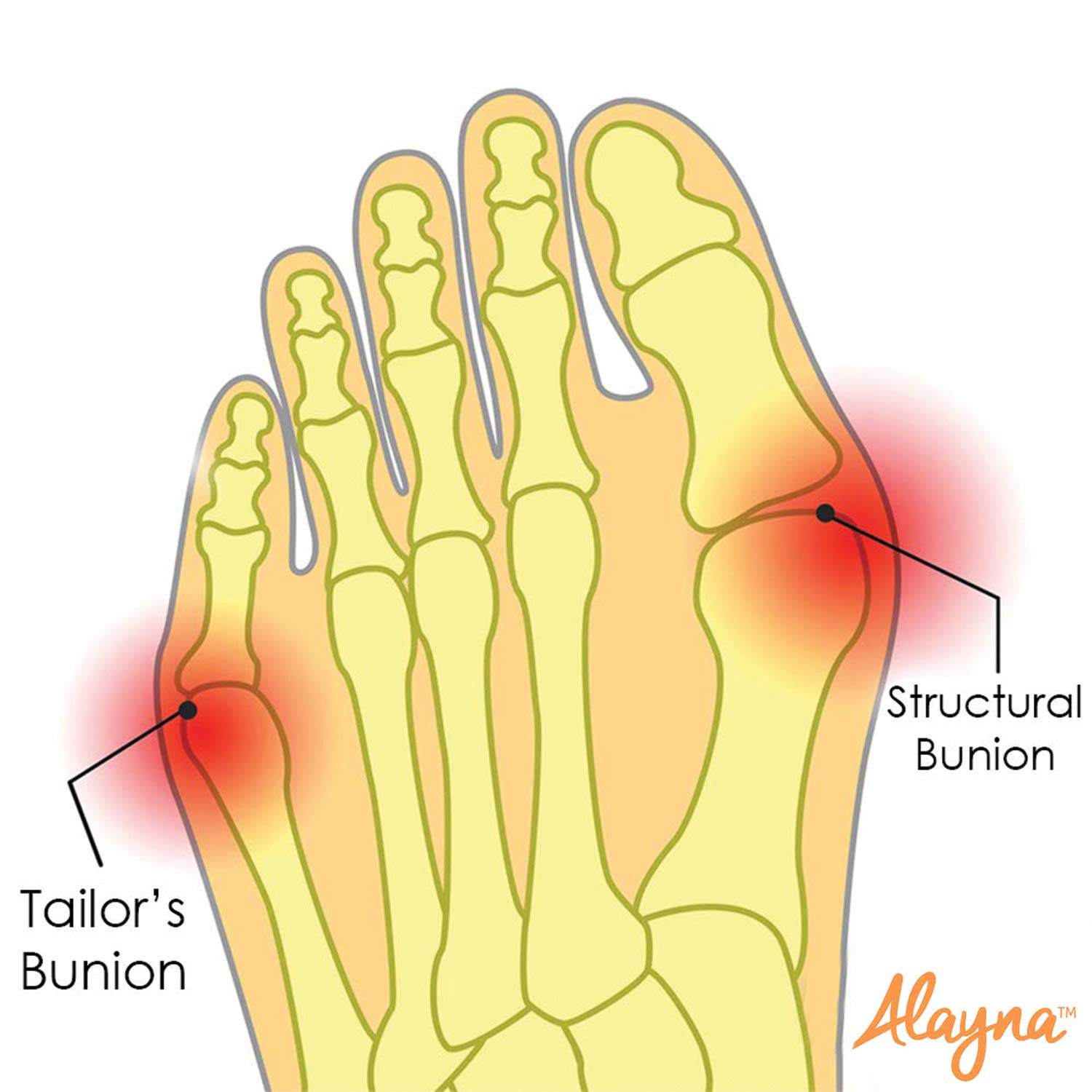 Alayna MEDIUM Bunion Corrector with Non-Slip Grip Insert and Gel Cushion Pad Splint Orthopedic Bunion Protector and Pain Relief Men/Women - Hallux Valgus Realignment Stops Bunion Pain (2 PCS) : Beauty