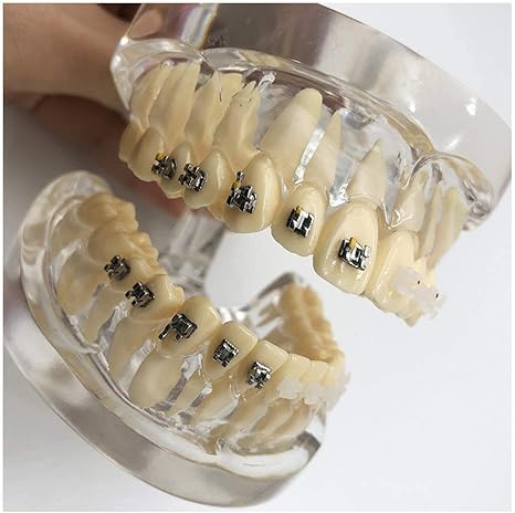 Amazon Co Jp 対照的矯正モデル 教示モデル歯 金属とセラミックの歯モデルスタジオ 2個 と歯科矯正治療 A ホーム キッチン