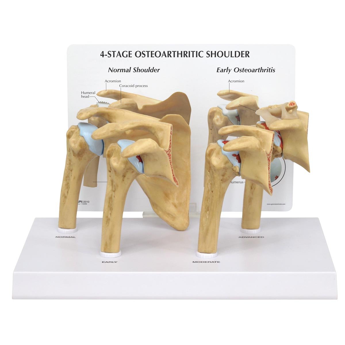 3B Scientific 4 Stage Osteoarthritis (OA) Shoulder Model