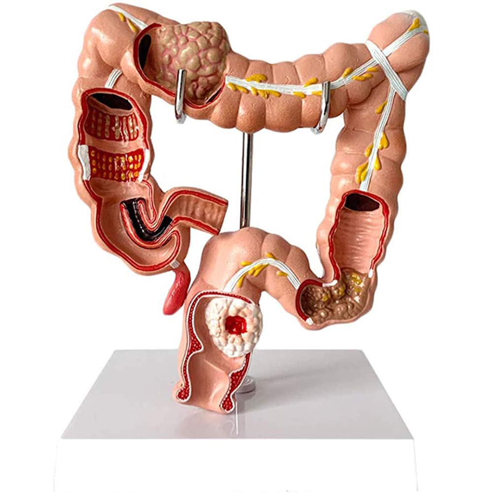 Human Large Intestine Anatomical Model-Colon Lesion Model-Anorectal Gastroenterology Large Intestine Model-Anatomical Digestive System Research Teaching