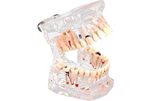 Walfront Teaching Teeth Model Standard Tooth Model for Demonstration Disease Education (#3)