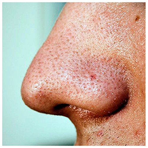 SEKI EDGE SS-801- Blackhead Remover