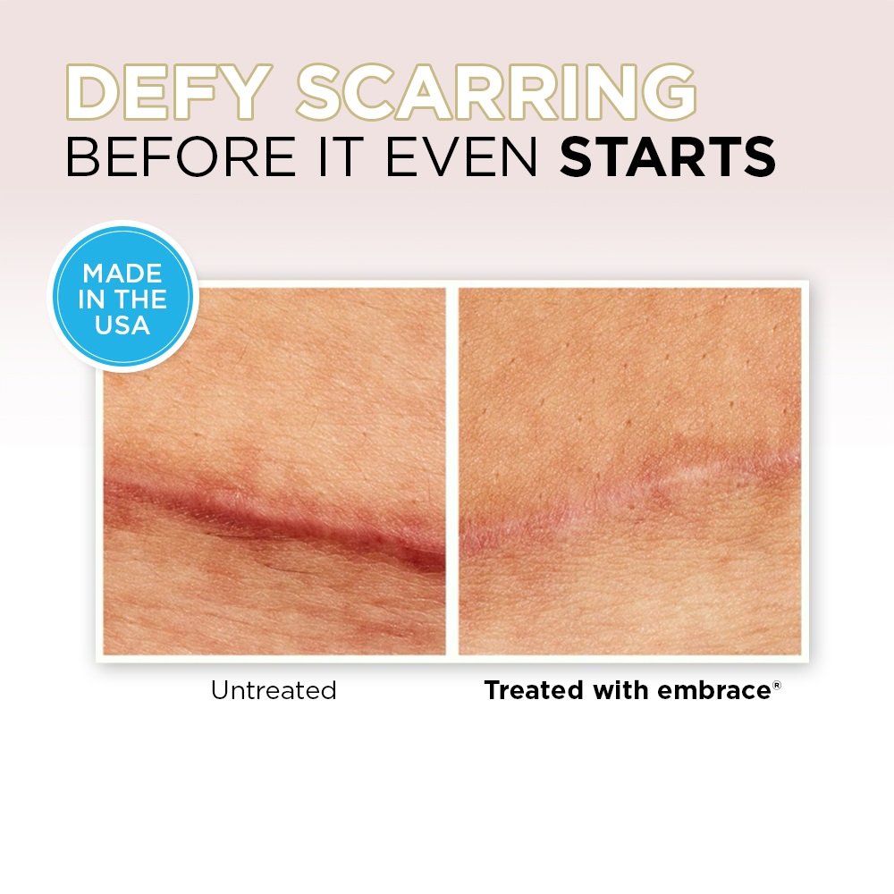 Acne Scar Treatment Embrace Active Scar Defense Scar Reducing Treatments