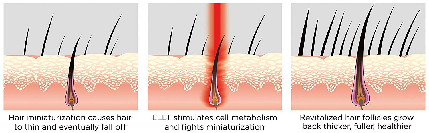 iRestore Laser Hair Growth System - FDA Cleared Hair Loss Treatments - Hair Regrowth for Men and Women with Balding, Thinning Hair - Laser Cap Uses Red Light Therapy Like Laser Comb Hair Loss Products: Beauty