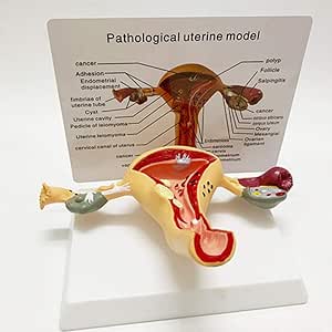 GYJ Modelo de patología uterina, Modelo de útero y Ovario ...