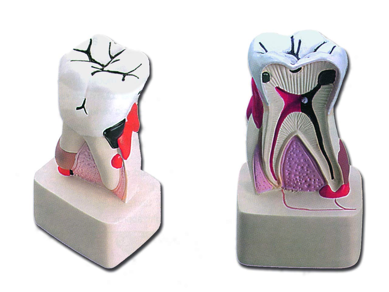 Gima - Anatomical Model of Lower Molar with Dental Pathologies, Highly Detailed, Magnification 4 X