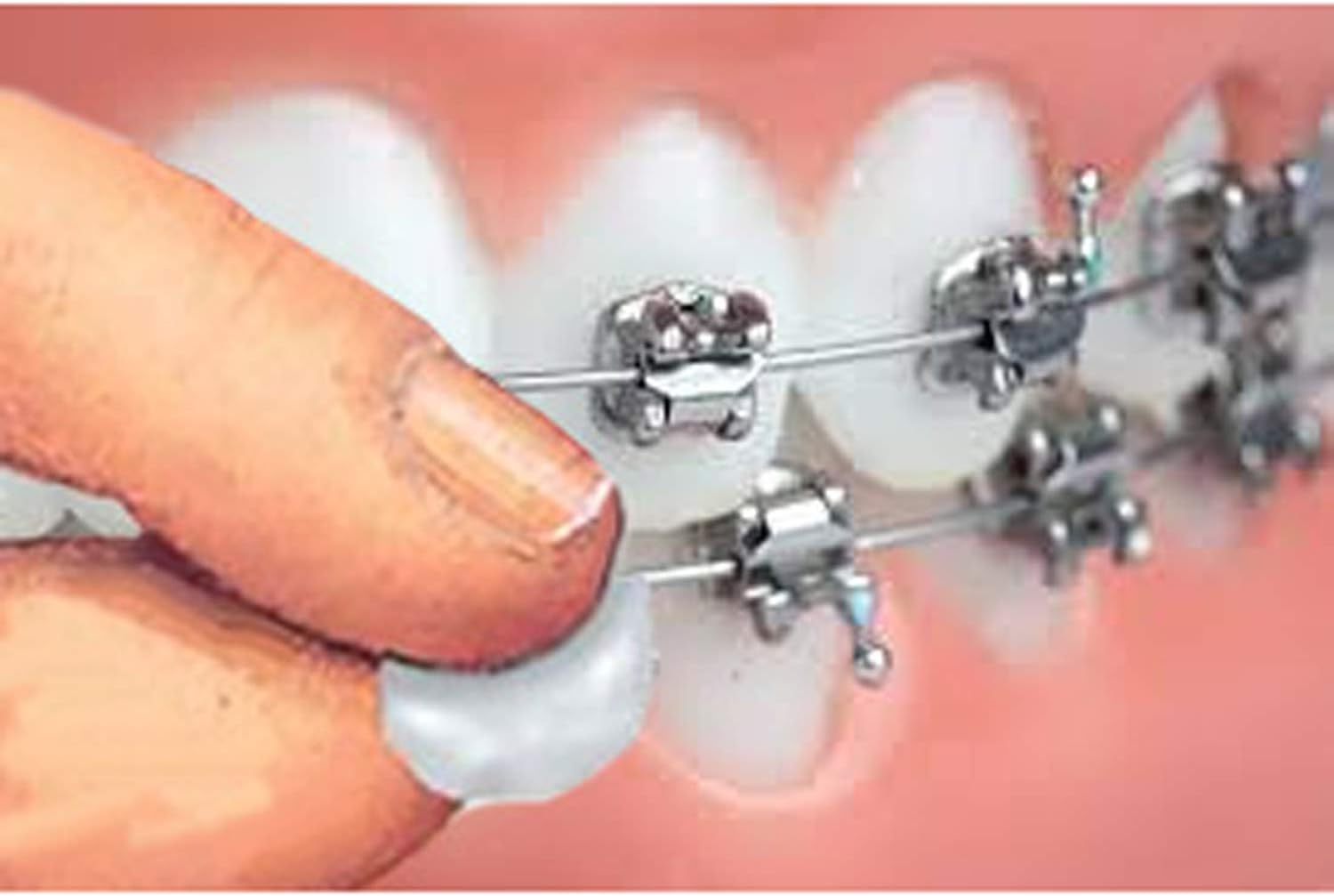 Genuine Orthowax - Our BestSeller Orthodontic Wax for Braces Wearer - Stick Better Than competitors: Health & Personal Care
