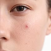 DOTTY 36 Count Pimple Patches for Face, Hydrocolloid Acne Patch, Acne Stickers for Covering Cheeks, Forehead, Chin Blemishes Zit Breakouts for All Skin Types