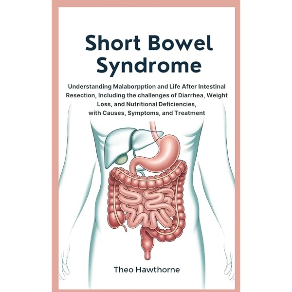 Short Bowel Syndrome: Practical Approach to Management: DiBaise