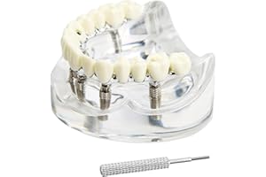 KOUYOT Dental Model Overdenture Transparent Dental Implant Model Upper Jaw Typodont Implant Model Removable Denture Model Suitable for Education and Study