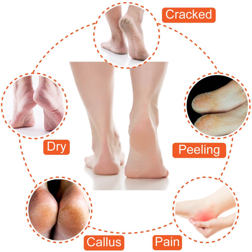 Selizo 5 Pairs Moisturizing Gel Heel Socks Open Toe Socks for Dry Hard Cracked Heels, 5 Colors : Beauty