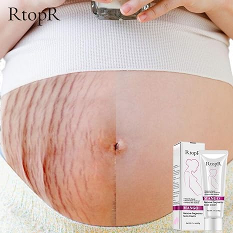 Taykoo Mango Remove Pregnancy Scars Acne Cream Stretch Marks Treatment Maternity Repair Anti Aging Anti Winkles Firming Body Creams Amazon Ca Beauty