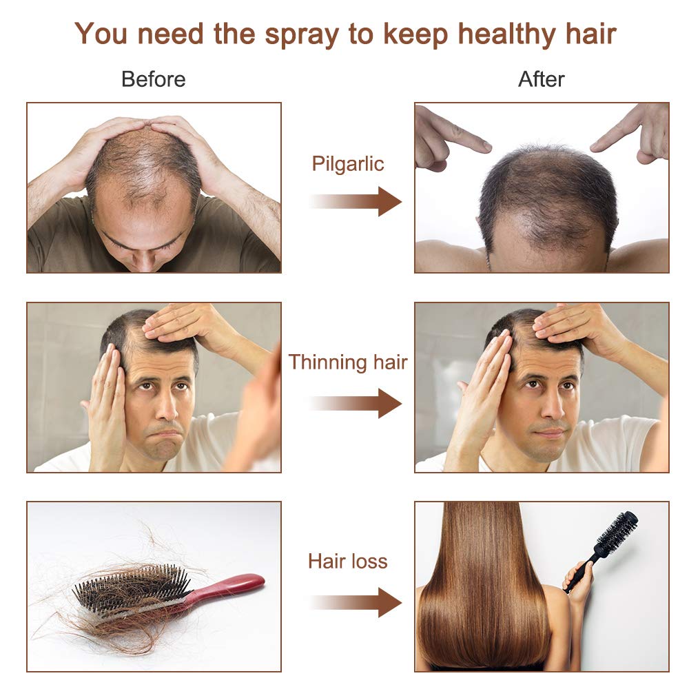 Hair Grow Spray, Anti Hair Loss, Thinning, Balding, Natural Ingredients Hair Regrowth Treatment for Stronger, Thicker, Longer Hair Grow, Repair Hair Follicles, All Hair Types, Men and Women : Beauty