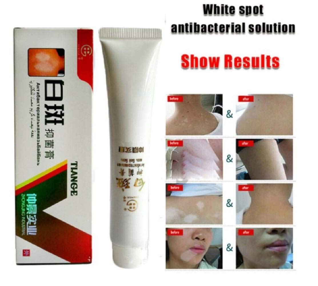 Amazon Com Tssplus 30g Chinese Medical White Spot Disease Cream