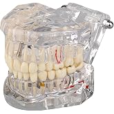 Ultrassist Transparent Dental Disease Teeth Model with Removable Teeth | Dental Pathology Demonstration Model for Dentist Patient Education &amp; Teaching