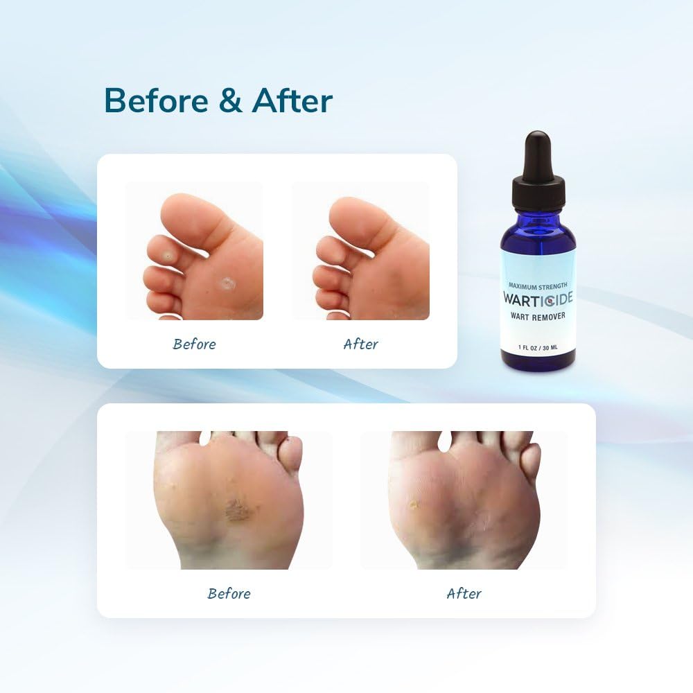 WARTICIDE Fast-Acting Wart Remover - Plantar and Genital Warts Treatment, Attacks Warts On Contact, Easy Application (1 Bottle): Health & Personal Care