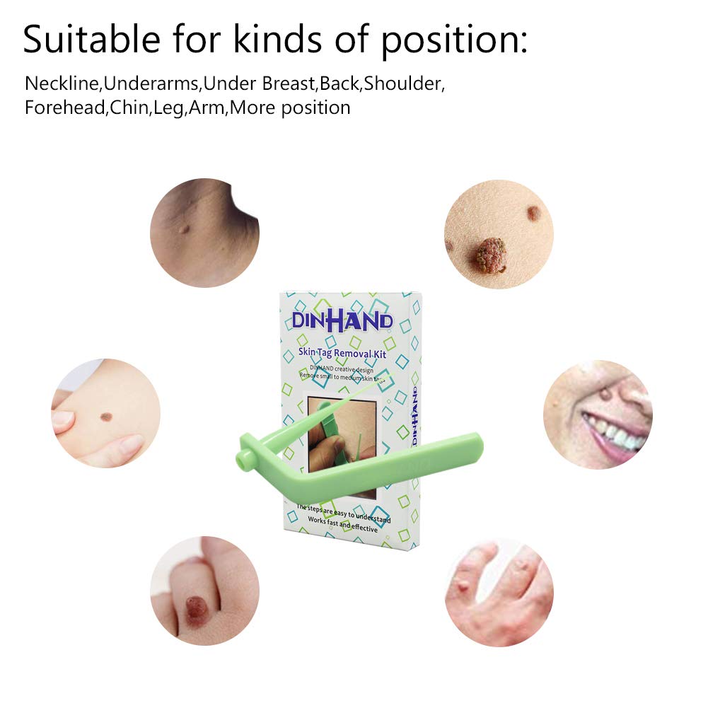 Micro Skin Tag Remover Device for Small to Medium Skin Tags : Beauty