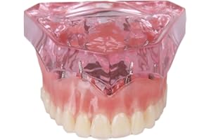 SOARDAY Dental Maxillary Overdenture Model with 4 implants Teaching Study Teeth Model
