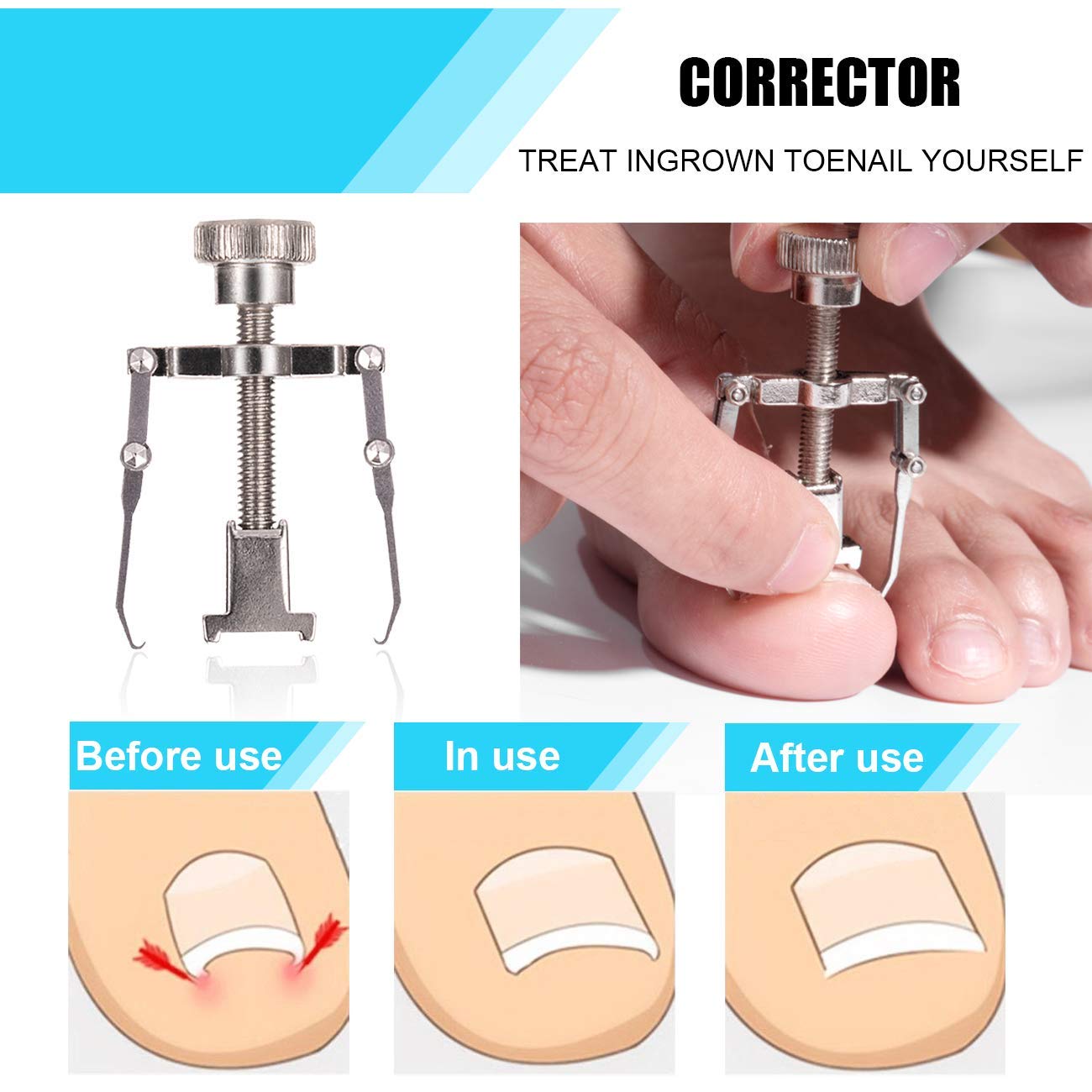 Ingrown Toenail Tool Kit (7PCS), Professional Toe Nail Clipper Set for Ingrown & Thick Nail, Stainless Steel Ingrown Toenail Kit, Surgery Grade Manicure Pedicure Tool By Dualeco: Beauty