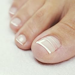 CurveCorrect® Ingrown Toenail Treatment Kit