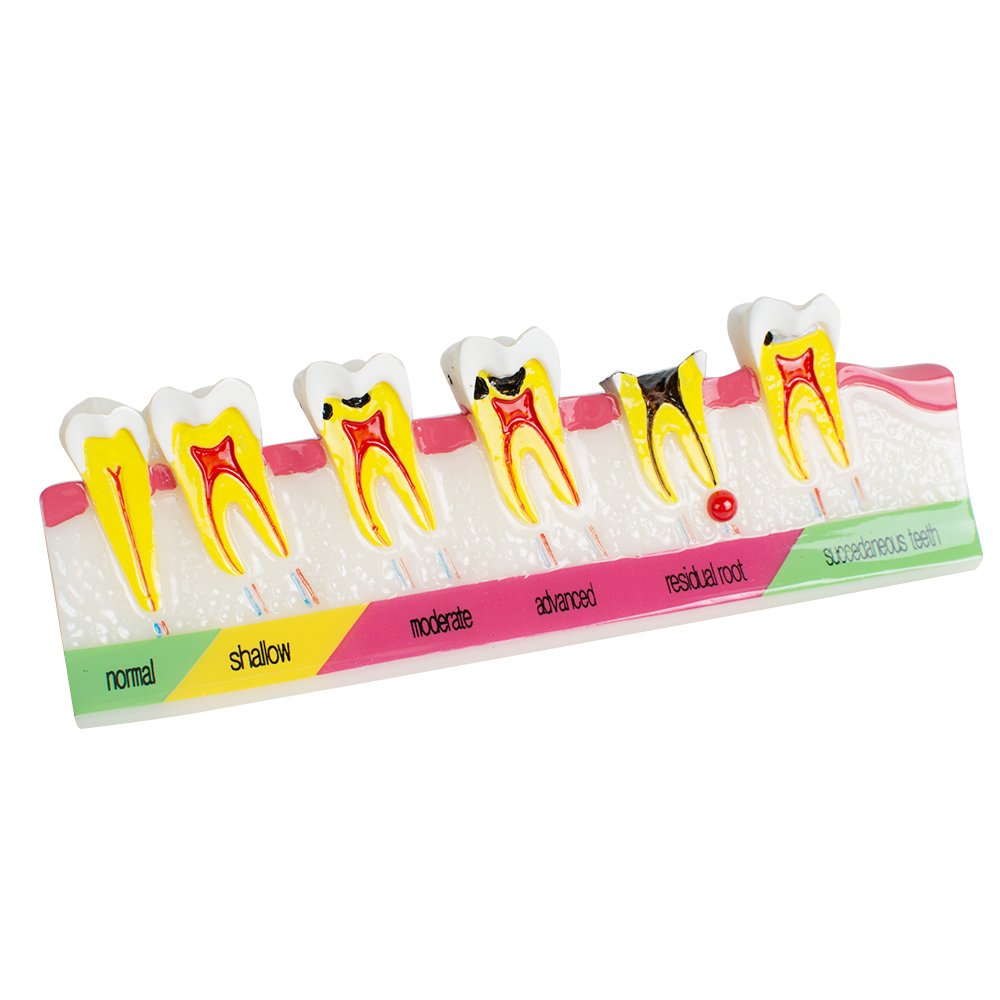 Pevor Dental Teeth Model Periodontal Disease Assort Tooth Typodont Study Teaching Model