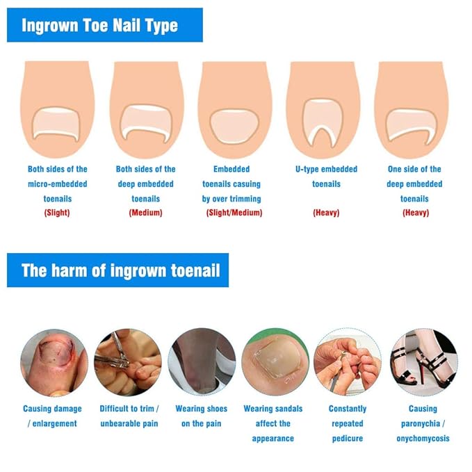 Ingrown Pincer Nail Correction Set 