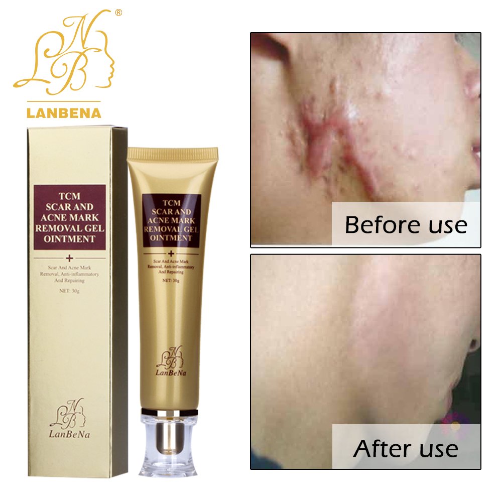 lanbena stretch mark