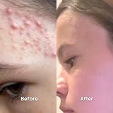 Salcura Antiac Activ Liquid Spray 100ml Oily Congested Acne Prone Skin view 4