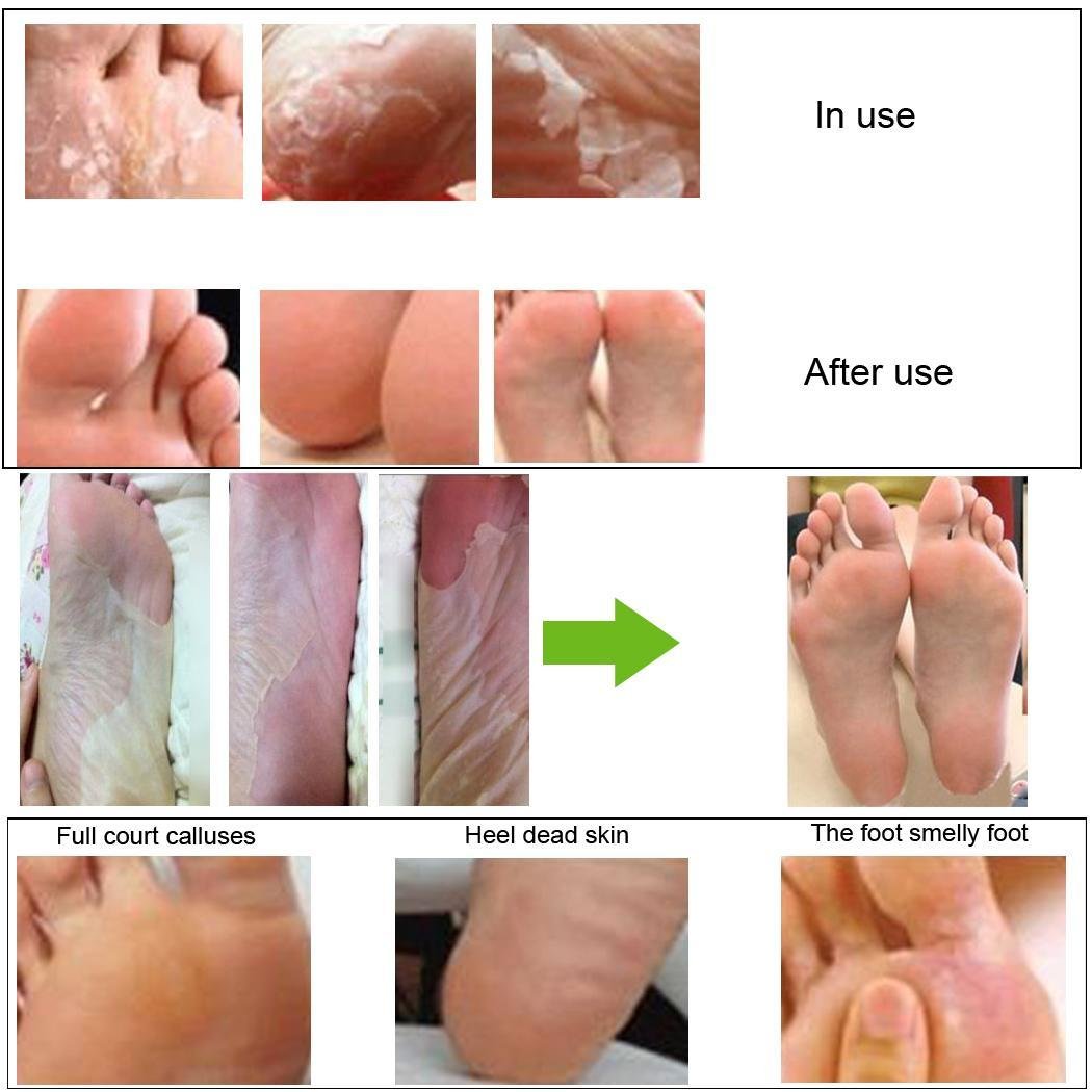 Minlop Peeling Fußpeeling Fußpflaster Erneuerungsmaske Entfernen Sie Harte Abgestorbene Haut Nagelhaut Ferse Fusspflaster, 1 Paar