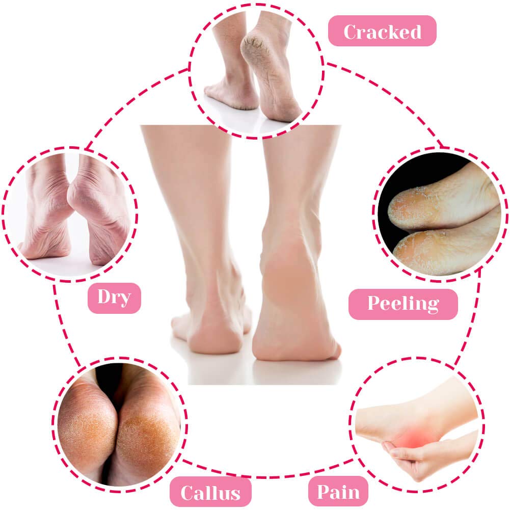 Selizo 6 Pairs Heel Moisturizing Socks Open Toe Socks Cracked Gel Heel Socks Foot Toeless Cooling Heel Repair Socks for Women Dry Hard Cracked Feet, 6 Colors : Beauty