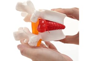 RONTEN Lumbar Disc Herniated Model, Human Anatomical Lumbar Spine Model for Medical Teaching & Learning