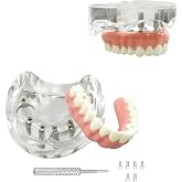 New Dental Implant Model, YOUYA DENTAL All-On-6 Implants Upper Jaw Malone Bridge Teeth Models, Dental Overdenture Teeth Model with Removable Recondition Implants for Education Teaching