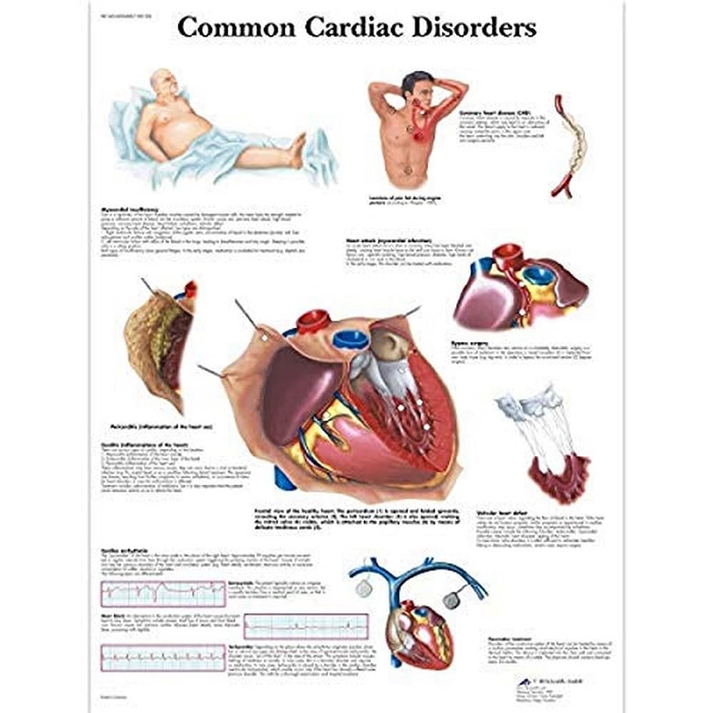 3B Scientific Human Anatomy - Common Cardiac Disorders Chart, Paper Version