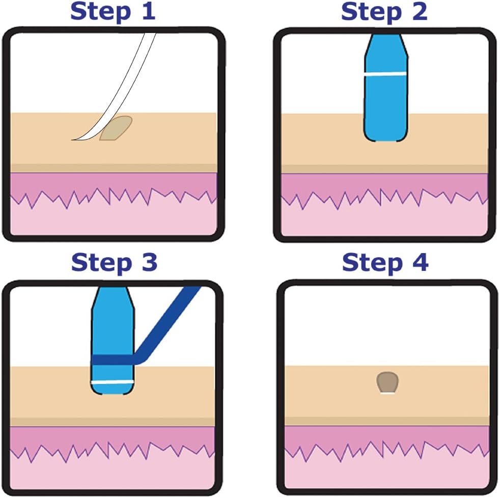 TagBand Skin Tag Removal Device for Medium to Large Skin Tags: Office Products