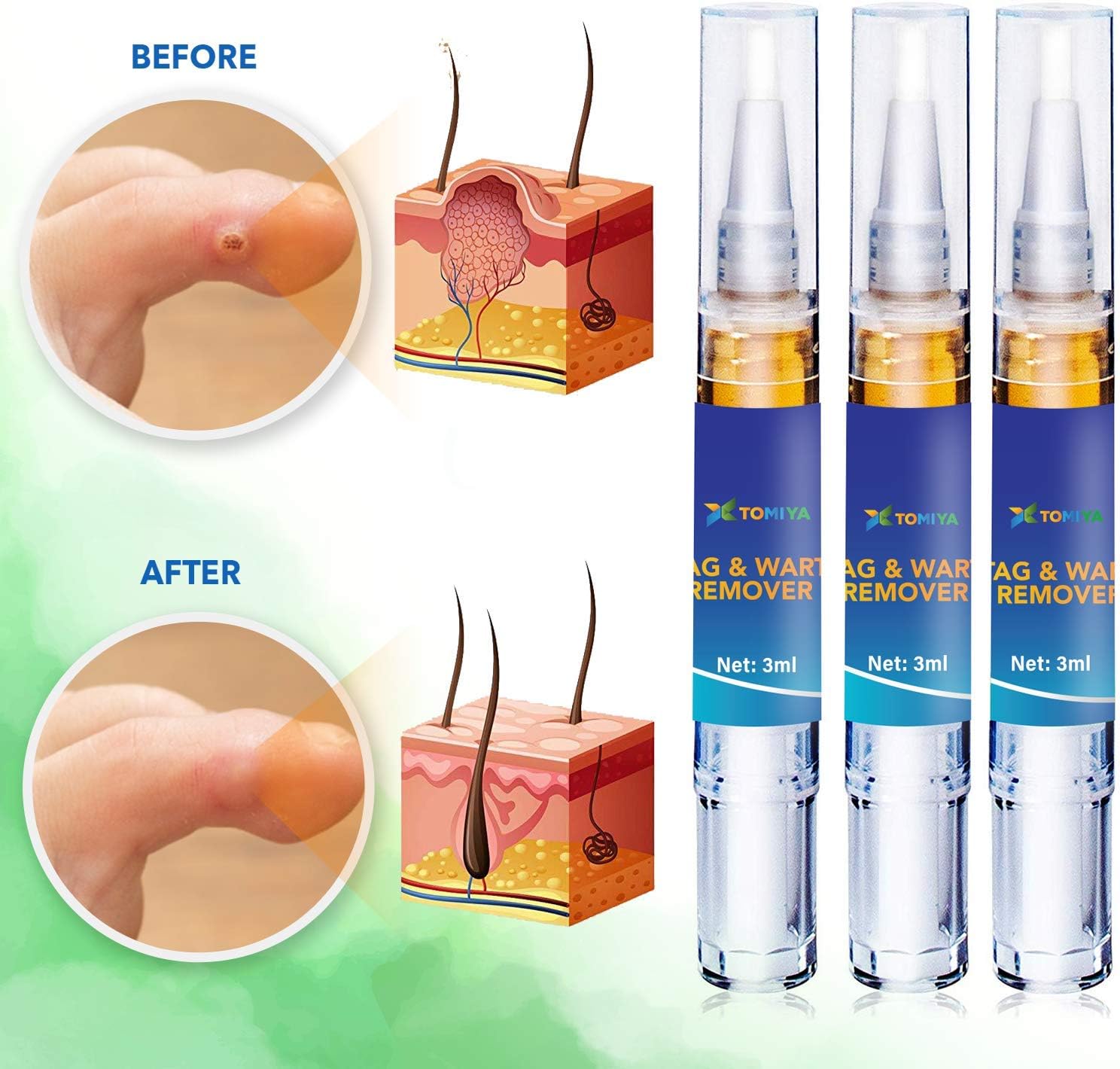 Tomiya Skin Tag Remover - Wart Remover - Quickly Remove Common And Plantar Warts - Corns - Callus -Skin Tag Removal(4 Packs) (Blue): Health & Personal Care