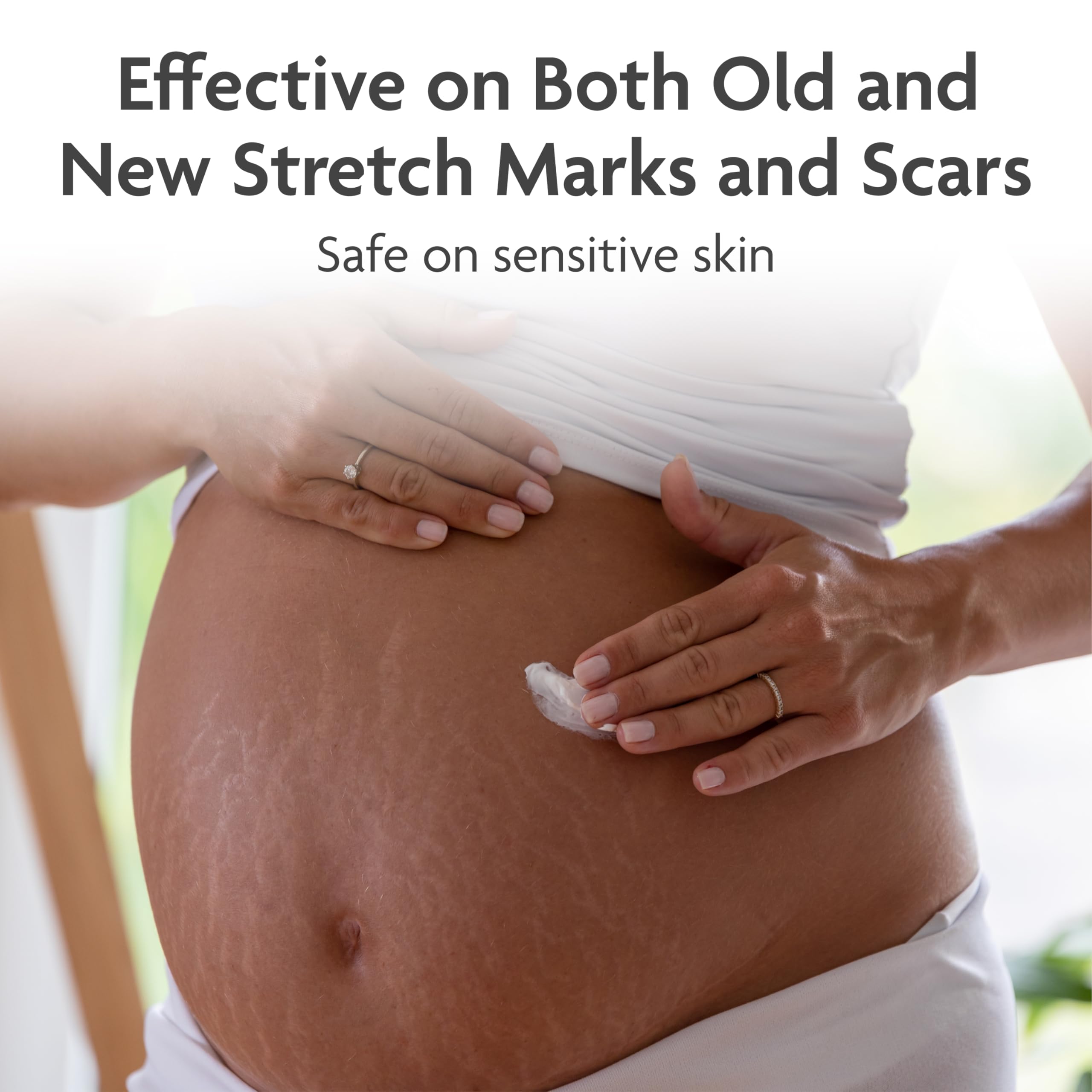 TriLASTIN Stretch Mark Cream for Pregnancy - 5.5 Oz Tube - Vitamin-Infused Cocoa Butter Formula - Intensive Scar Treatment - Hypoallergenic & Paraben-Free
