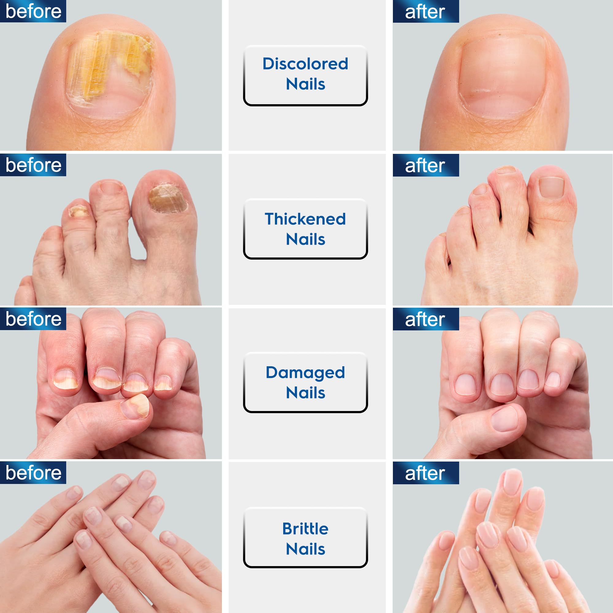 OSIMOON Toenail Fungus Treatment Extra Strength, Fungus Treatment for Toenails and Fingernails with Natural Oils, Toe Nail Fungus Treatment for Men and Women 2pcs., Blue - Image 4