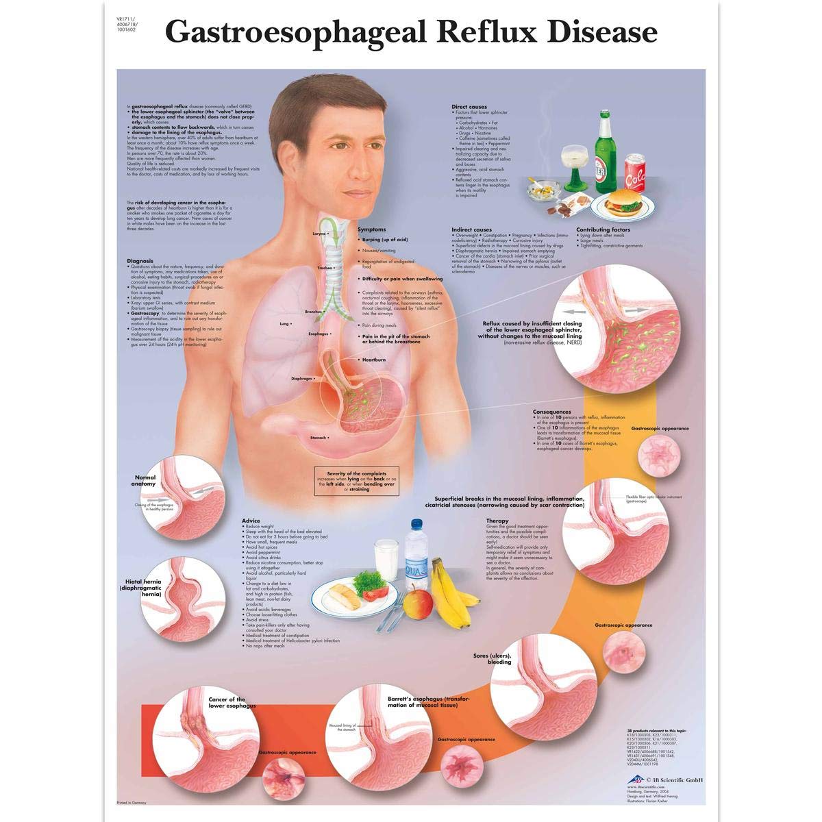 3B Scientific Human Anatomy - Gastroesophageal Reflux Disease Chart, Laminated Version